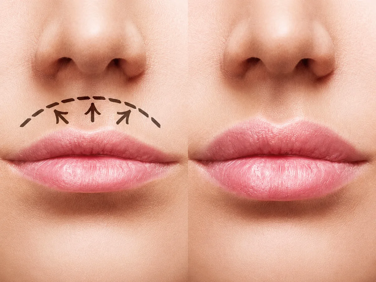 Lifting Labial