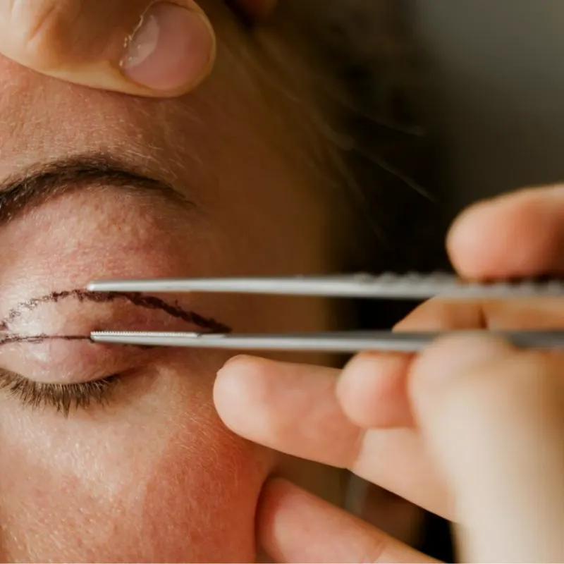 Blefaroplastia Superior e Inferior