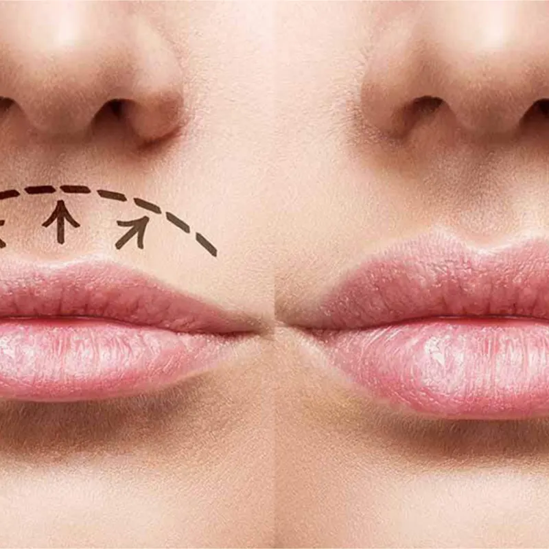 Lifting Labial