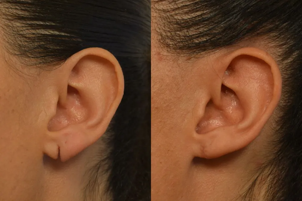 Lobuloplastia